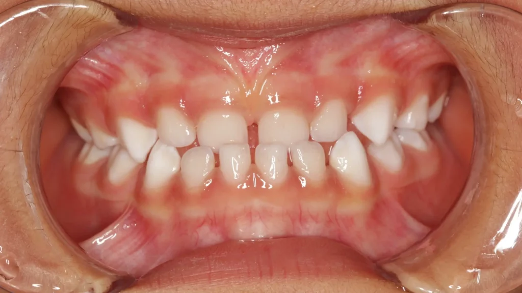 ma oclusao dentaria em criancas