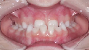 má oclusão dentária em crianças