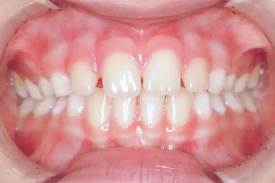 Mordida Cruzada | Depois