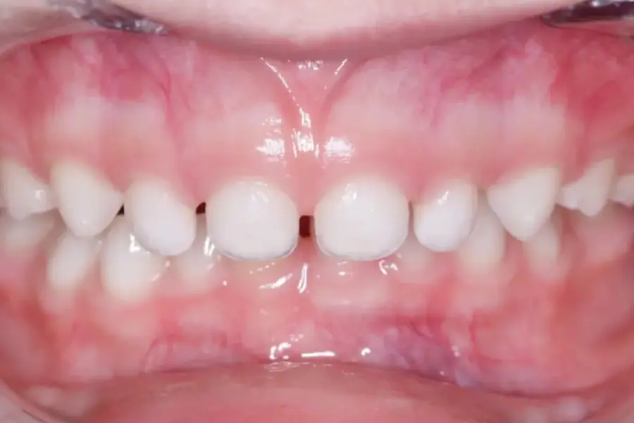 Retrognatismo Mandibular | Antes