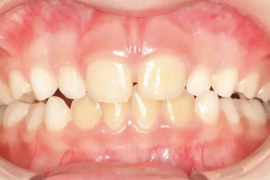Retrognatismo Mandibular | Depois