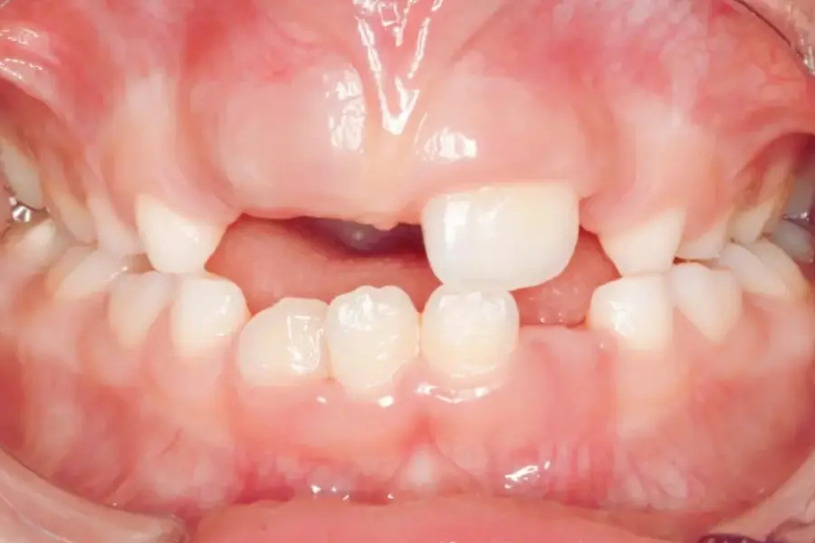 Ulectomia | Antes