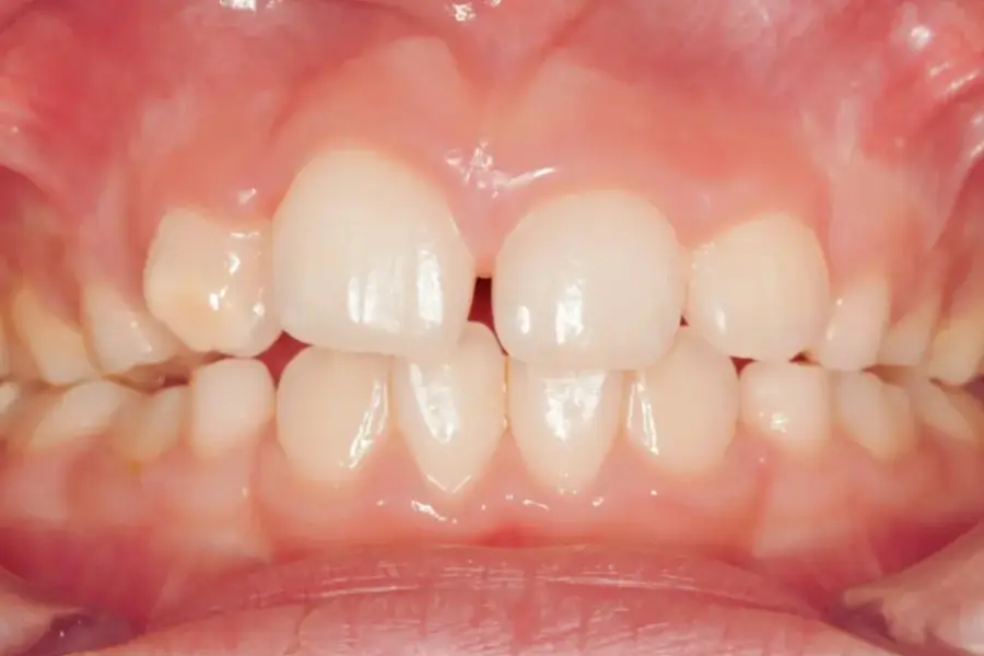 Ulectomia | Depois